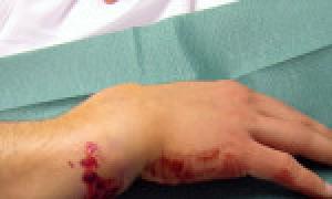 Зсув кісток при переломі руки: симптоми і дії при травмі